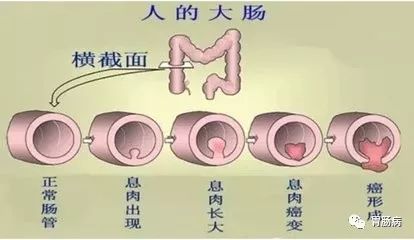 是大肠黏膜的溃疡在愈合过程中纤维组织增生及溃疡间黏膜下水肿,使