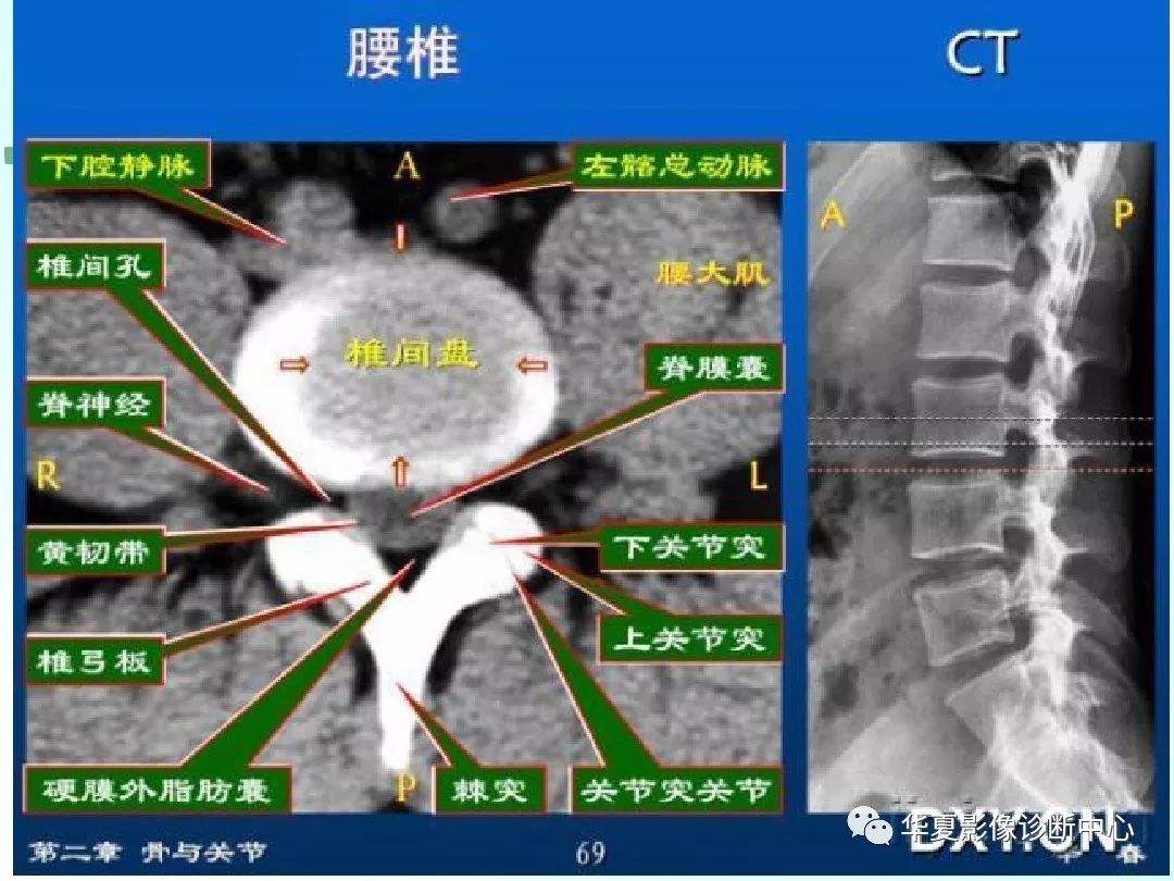 【影像基础】dr.x 教你怎么看椎间盘突出!