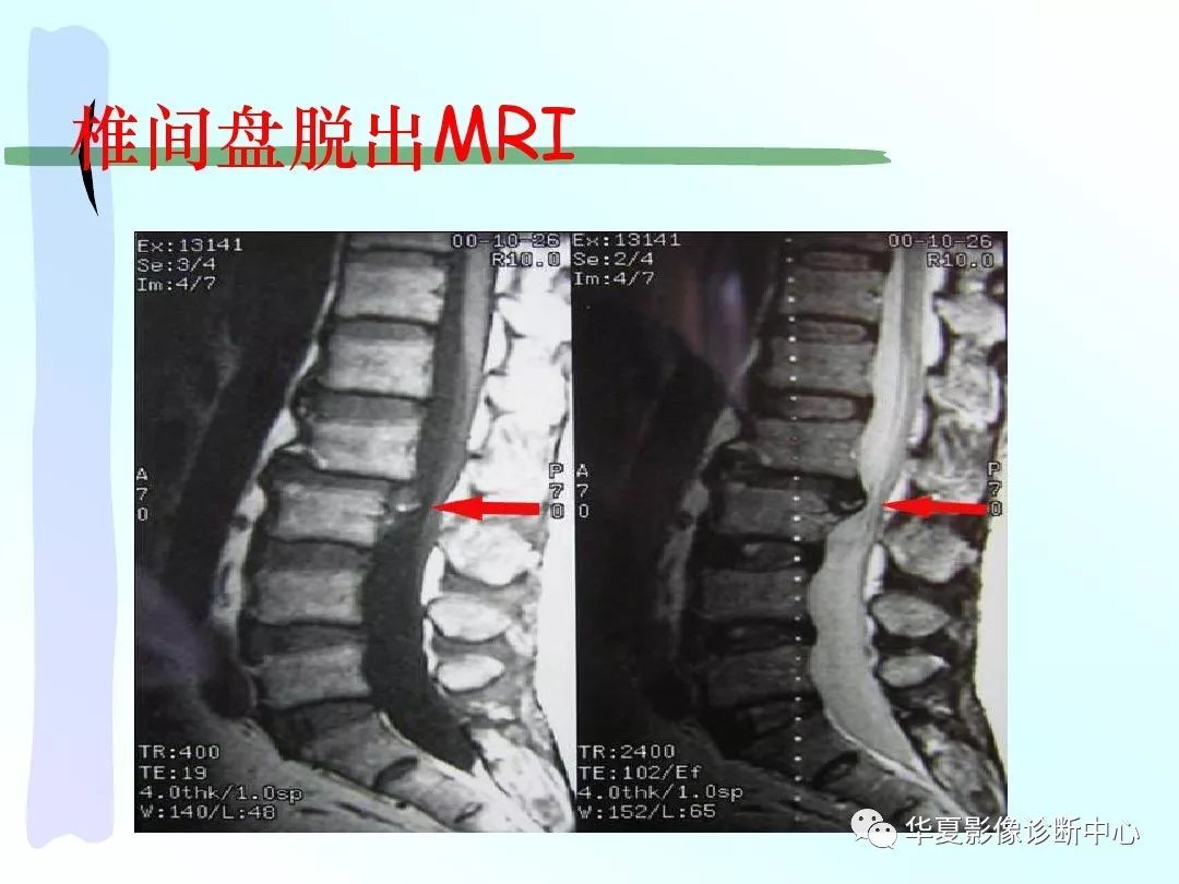 【影像基础】dr.x 教你怎么看椎间盘突出!