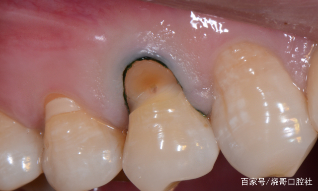 牙龈漏出来一点,稍微能看见牙根,每次刷牙很疼,是怎么