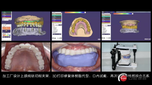 上颌无牙颌数字化导板种植修复一例