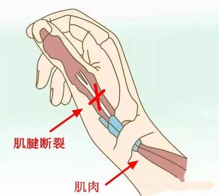 简单的说就是 就近"挪用"食指的一根肌腱,把它与大拇指肌腱断端接起来