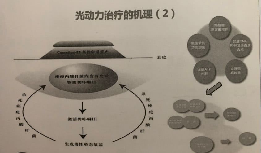 光疗的原理是什么_光疗笔是干嘛的(2)