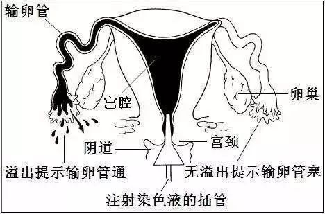 【孕育科普】输卵管造影后,多久能同房?