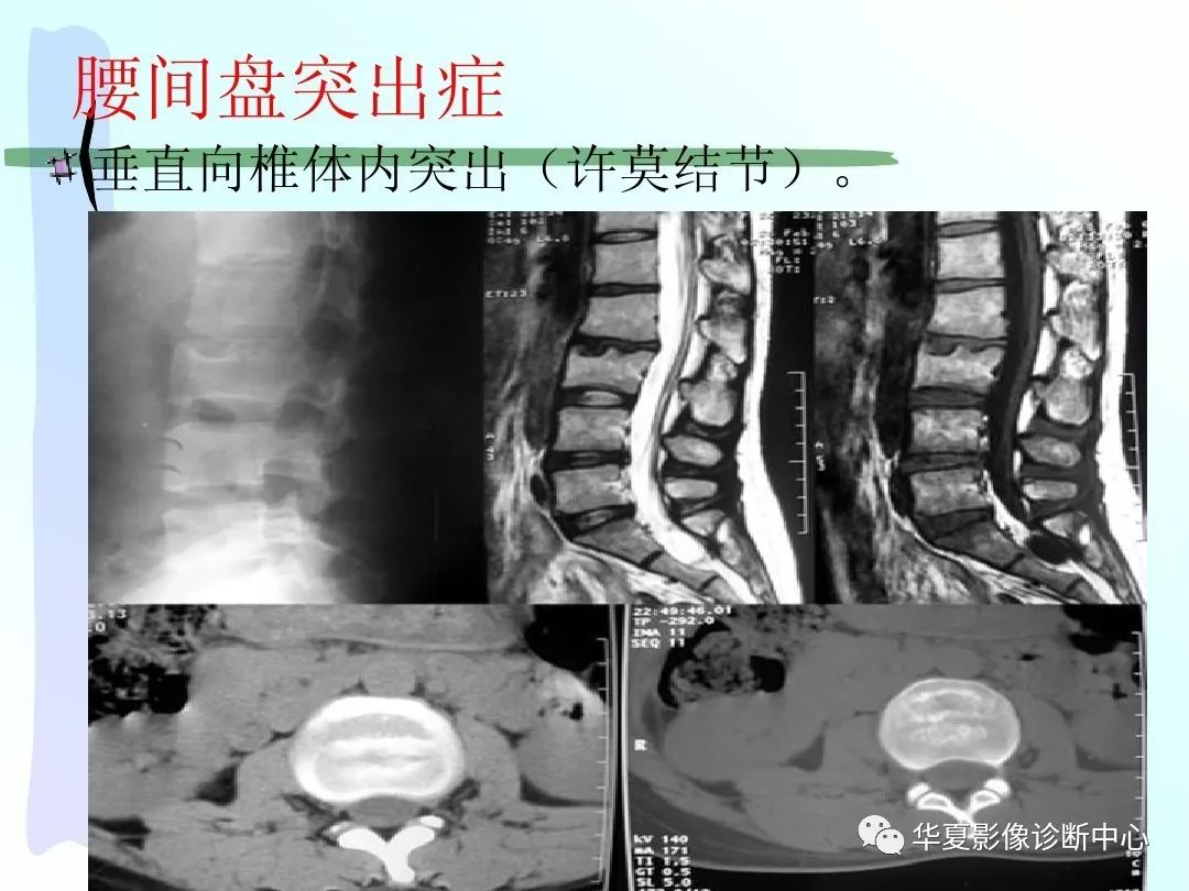 影像基础drx教你怎么看椎间盘突出