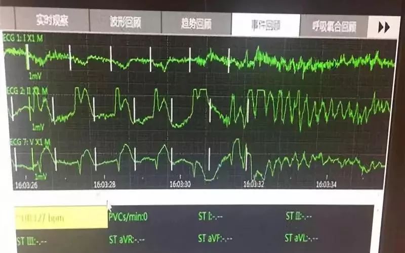 心电监护显示室颤图形