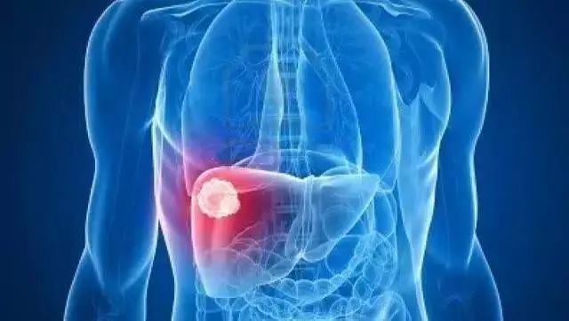 北大外科專家羅成華：警惕這幾種胃癌的常見症狀 健康 第2張