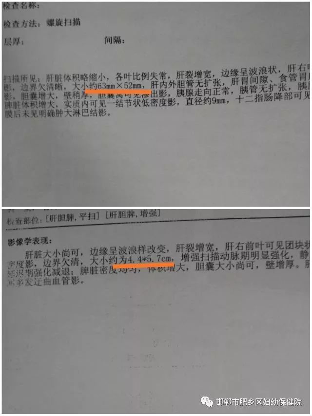 毒死肿瘤饿死肿瘤介入治疗我们用这样的方法来治癌