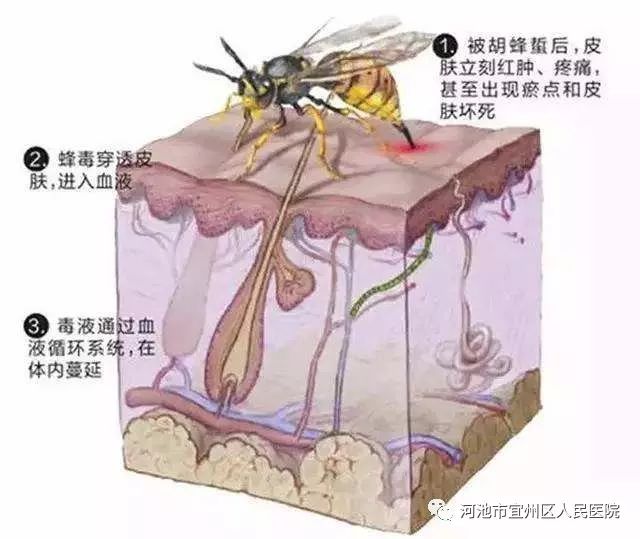 宜州:一男子被马蜂蜇伤40余处,多器官衰竭命悬一线!请