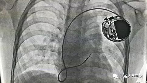 【医讯】我院首次独立完成床旁紧急临时心脏起搏器植入术