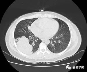 病例右肺下叶大片楔形实变影内见空泡征