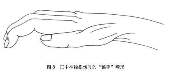 手部常见神经损伤的防治