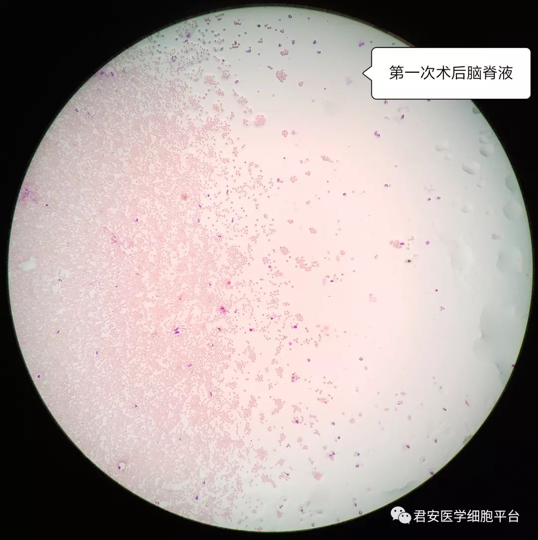 形态教学系列脑外伤病例的脑脊液细胞形态分析