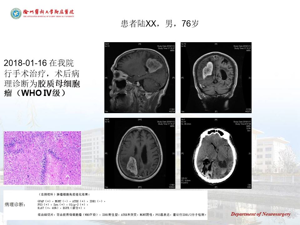 演讲徐医附院于如同脑胶质瘤分子病理诊断的临床意义