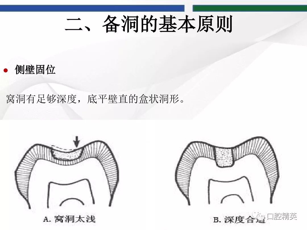 窝洞制备