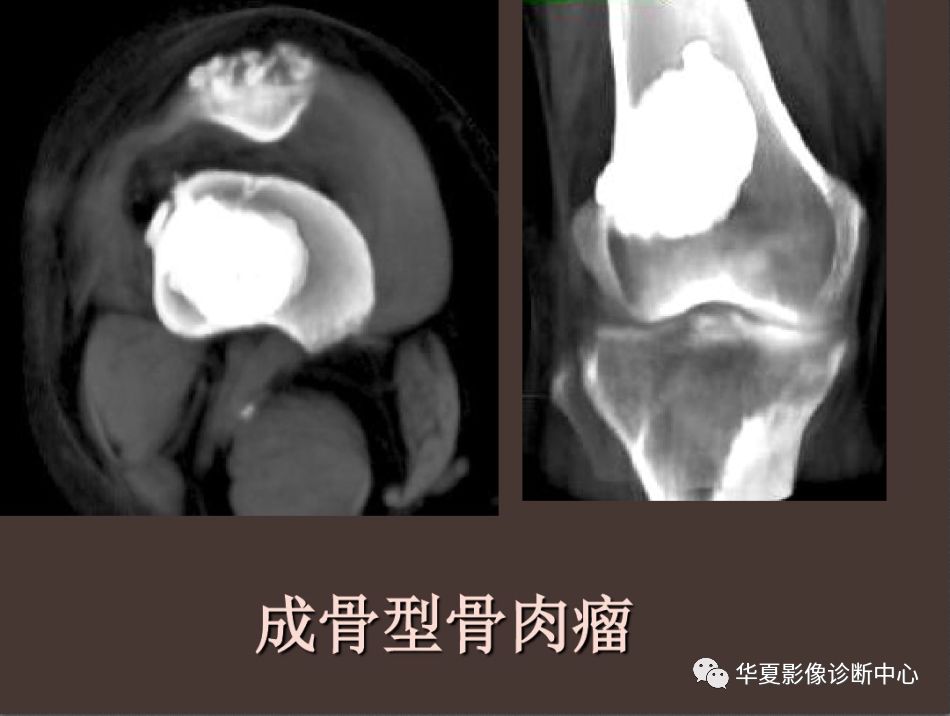 管状骨良恶性骨肿瘤的鉴别诊断