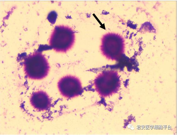 箭头所指 "物"名称  脑脊液涂片瑞氏—吉姆萨染色1000 × 新型隐球菌