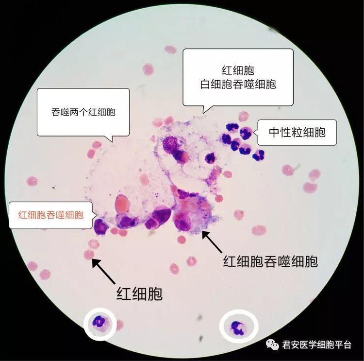 8mg/dl↑ 脑脊液常规结果 外观: 血性,浑浊 wbc 7360×106/l,rbc 6×