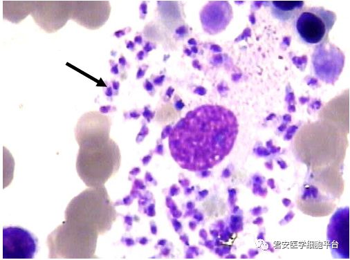 看图识细胞第34期2018年第1次浙江省体液形态学室间质评