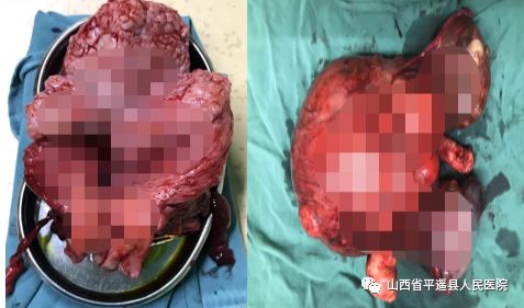术后笑容甜 ——平遥县人民医院妇产科成功切除2例巨大子宫肌瘤