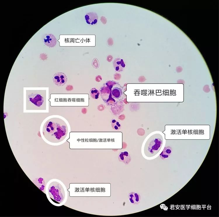 阳性(3 )wbc 7360×106/l,rbc 6×109/l外观: 血性,浑浊脑脊液常规