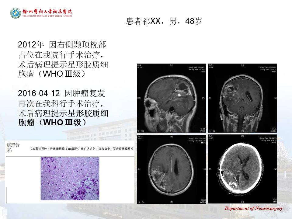 演讲徐医附院于如同脑胶质瘤分子病理诊断的临床意义