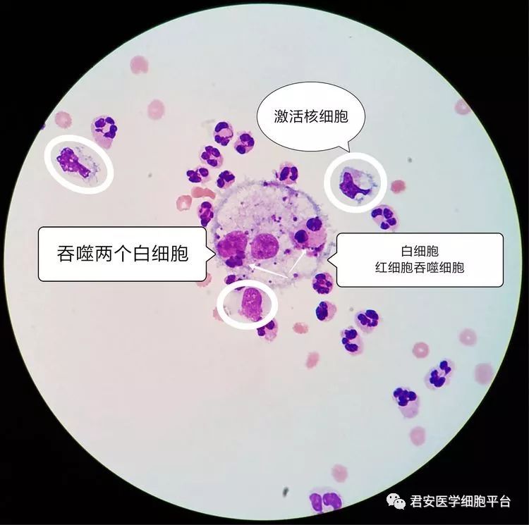 阳性(3 )wbc 7360×106/l,rbc 6×109/l外观: 血性,浑浊脑脊液常规