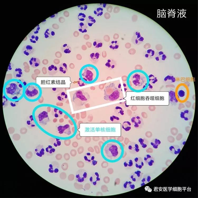 8mg/dl↑ 脑脊液常规结果 外观: 血性,浑浊 wbc 7360×106/l,rbc 6×