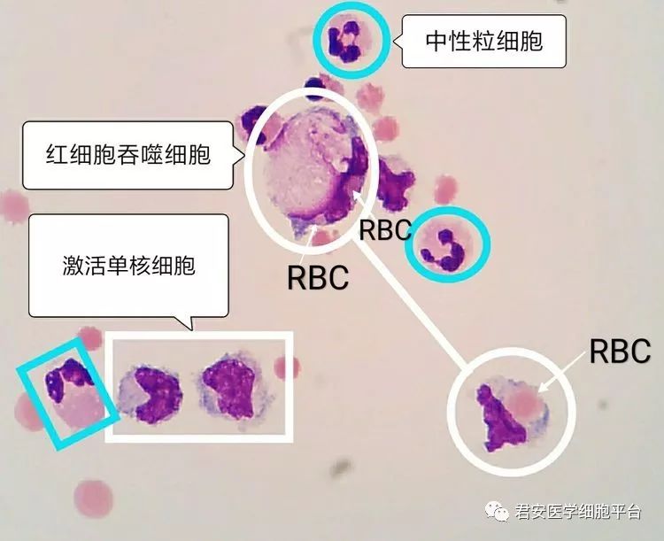 形态教学系列脑外伤病例的脑脊液细胞形态分析