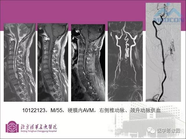 脊髓血管畸形:mr诊断 影像天地