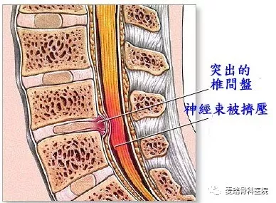 之所以腰腿痛会这样走窜,是因为腰椎的神根发生了炎症,水肿,缺血