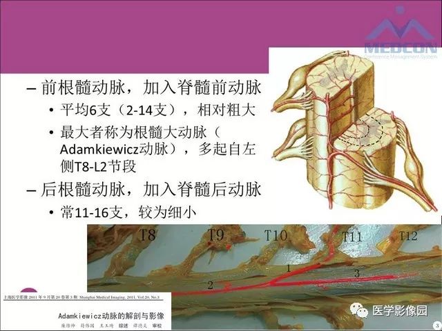 脊髓血管畸形:mr诊断 | 影像天地