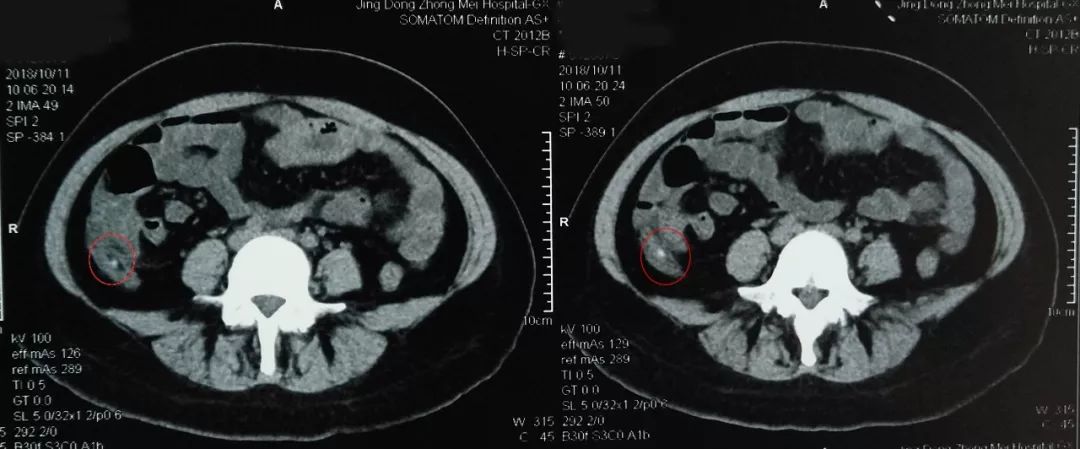 影像报告:ct检查结果报告阑尾粪石嵌顿