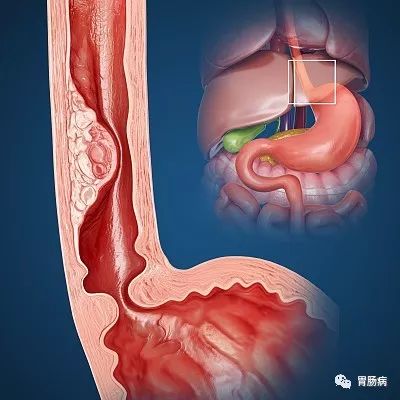 一,食管癌高危人群