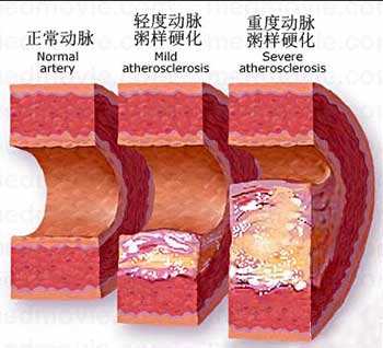 动脉硬化怎么回事?它是心血管疾病的罪魁祸首,如何用饮食控制?