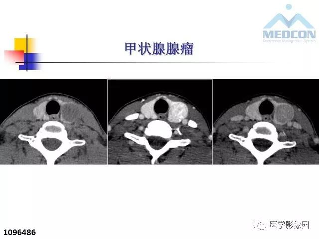 甲状腺疾病ct诊断思路与技巧 | 影像天地