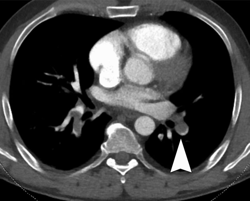 急性肺栓塞的肺ct血管造影