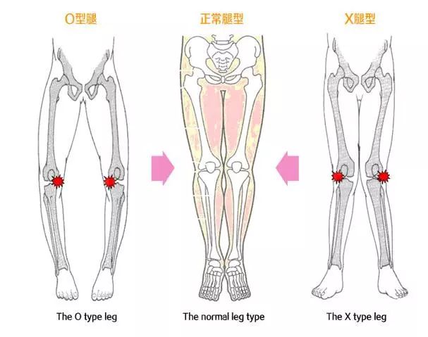 o型腿x型腿的人