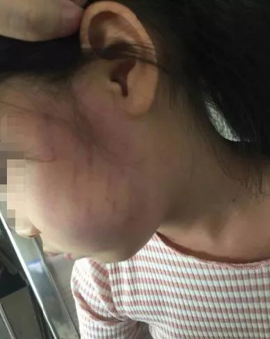 又有孩子被打广东4岁女童因哭闹被体罚脸都打肿了