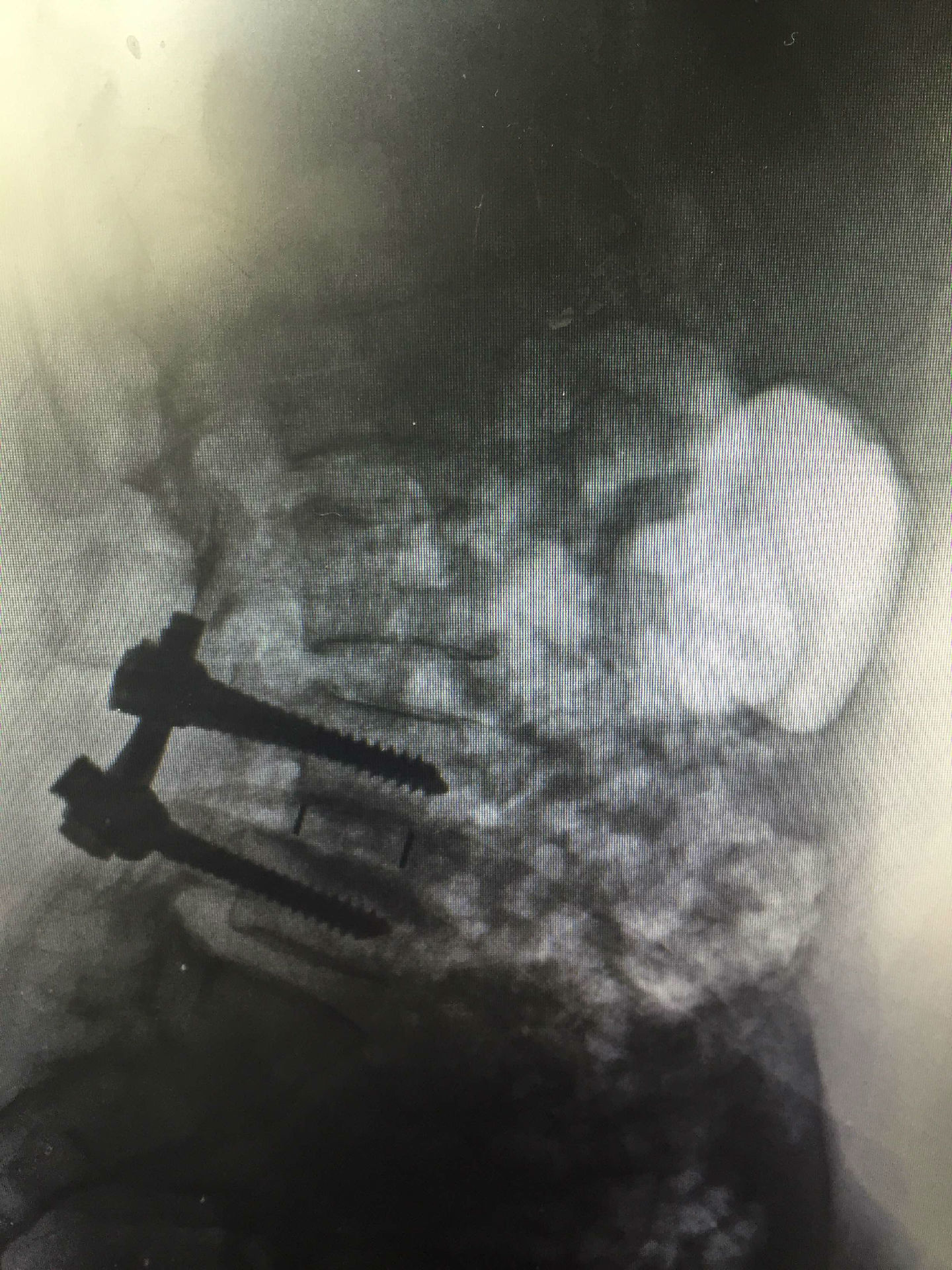 退变性腰椎滑脱科普一下（照片为腰椎滑脱手术前后X线片） - 好大夫在线