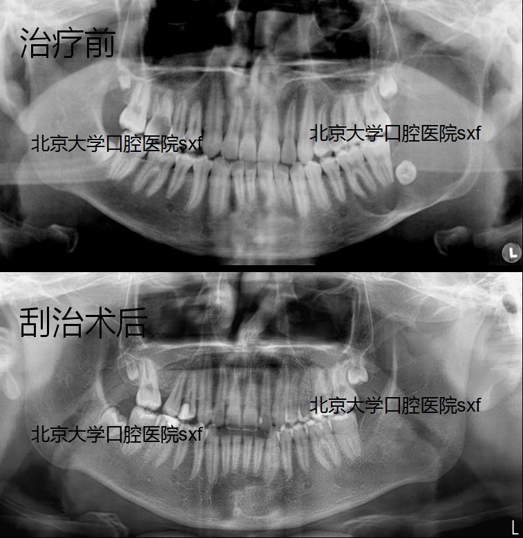 巨大成釉细胞瘤刮治后2年完全恢复