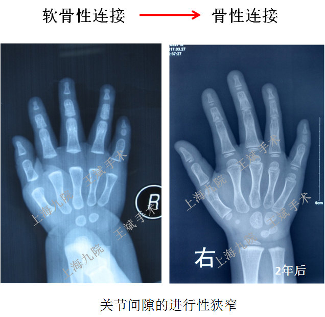 患者发现关节粘连后家长未及时进行手术,两年后发展为骨性融合,手指就