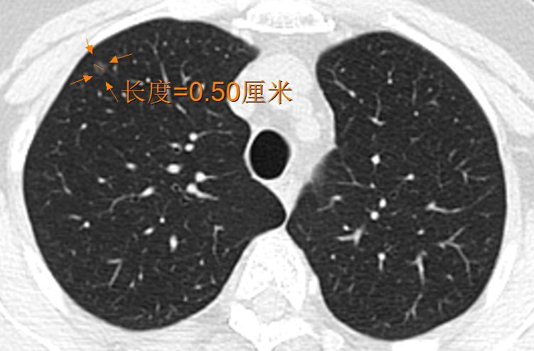 如何解读磨玻璃结节的ct报告?