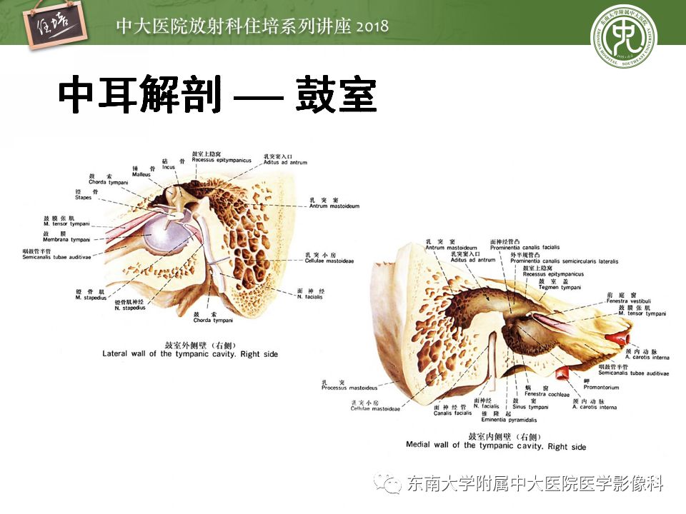 中耳解剖及中耳病变影像诊断