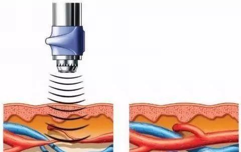 【技术】体外冲击波治疗前列腺炎,尿频尿急!让你不再讳疾忌医!