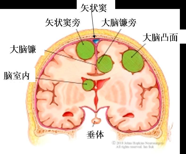 矢状窦及大脑镰旁脑膜瘤(额部或顶部脑膜瘤)手术_回流