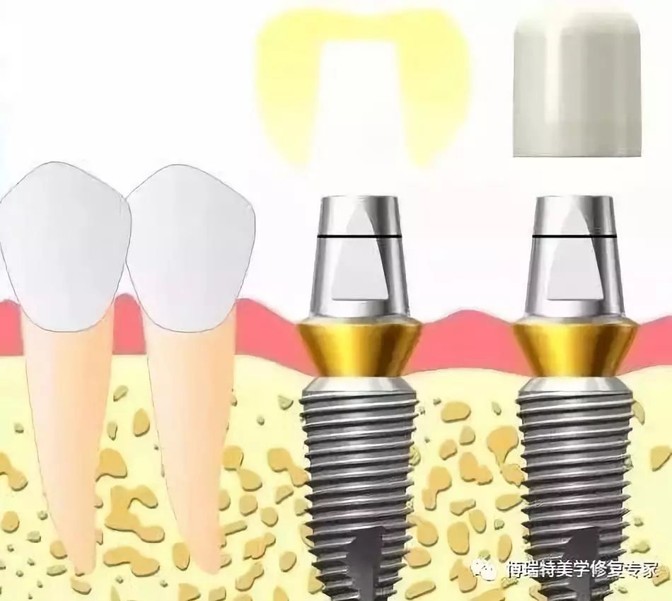 口腔种植印模及种植修复取模图解