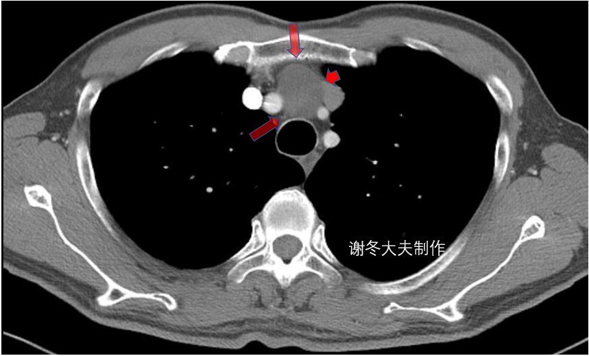 胸腺瘤前纵隔占位前纵隔结节是癌症吗