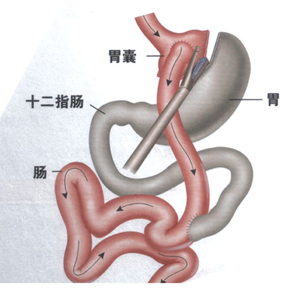 减肥手术哪种效果好_手术减肥_减肥手术有哪些方法