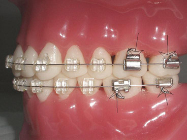 (2)不分牙的做法: 使用进口的粘结剂可以使用直接粘结的颊面管(如下